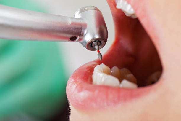 Best Emergency Dental Care for Abscessed Tooth in Unionville, GA